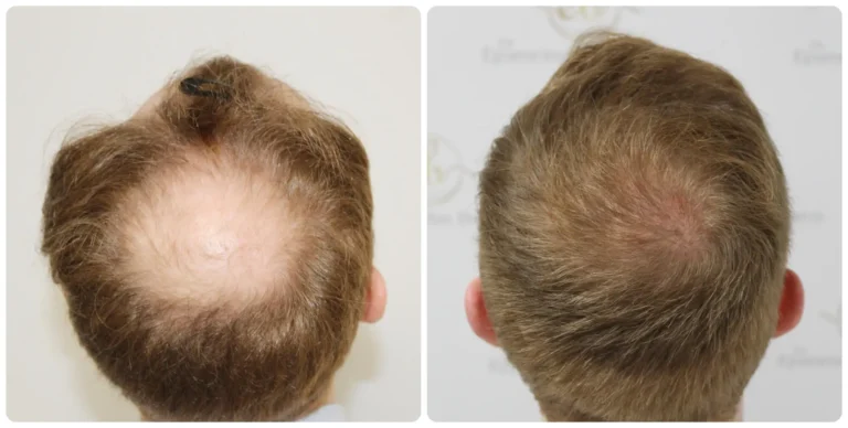 how long does it take for minoxidil to work